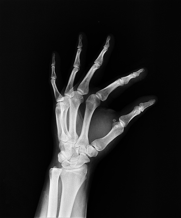 Myelom. Jde o nemoc, která vyrůstá z buněk kostní dřeně