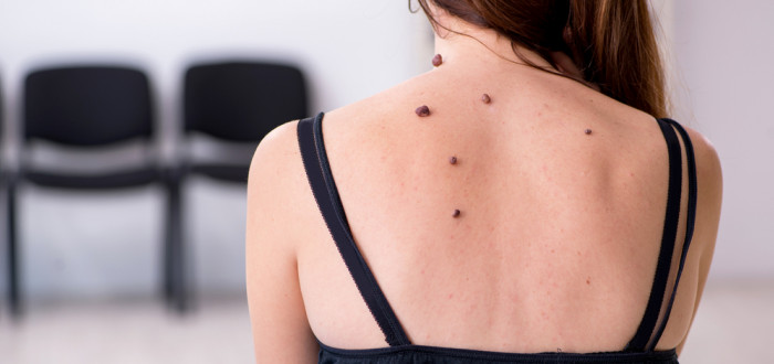 Bradavice jsou nezhoubné nádorky (novotvary) způsobené lidským kožním papilomavirem HPV