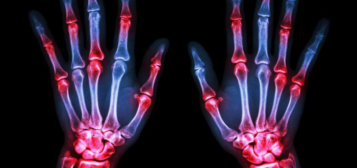 hogyan kezeljük a térd ligamentum sérüléseit