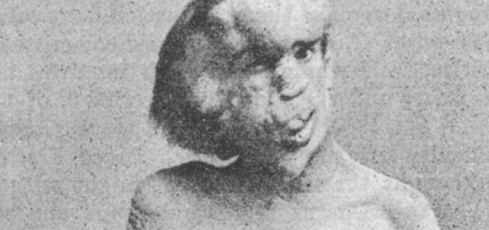 Kvůli svému vzhledu našel Joseph Merrick práci jen v panoptiku 