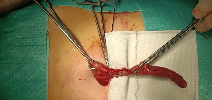 Foto: Operace apendixu