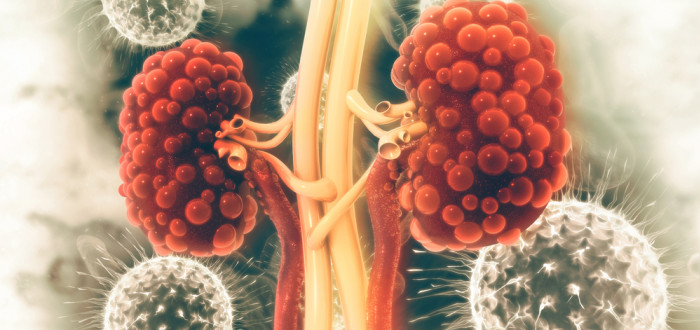 Polycystická choroba ledvin je dědičné onemocnění ledvin, které své nositele značně poškozuje a může je i ohrozit na životě