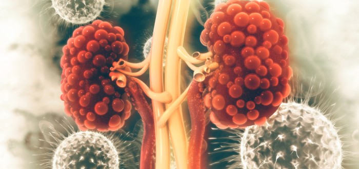 Polycystická choroba ledvin je dědičné onemocnění ledvin, které své nositele značně poškozuje a může je i ohrozit na životě