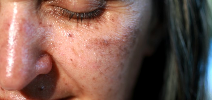 Pigmentových skvrn se můžete zbavit poměrně lehce, pomůže vám s tím mimo jiné i pravidelný peeling