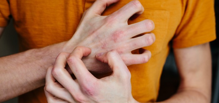 S ekzémem vám může pomoci i obyčejný slunečnicový olej