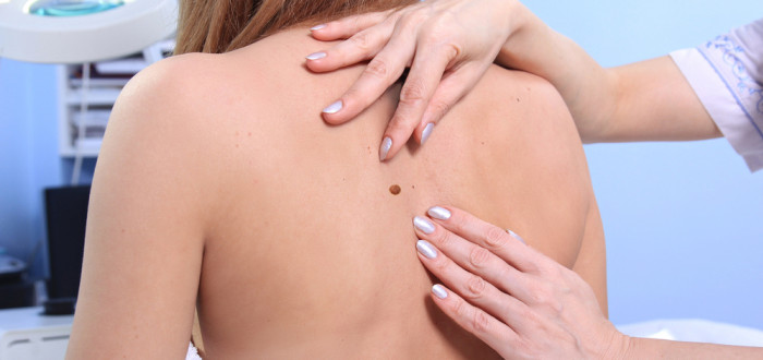 Lidé, kteří mají podezření na nezvyklé znaménkové útvary by měli jít na vyšetření, které dermatolog provede dermastoskopem