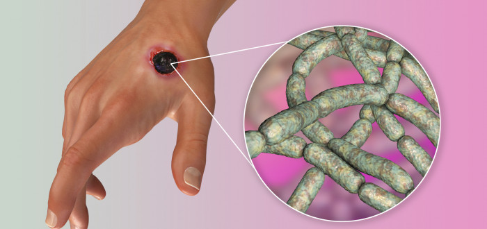 Antrax je vysoce infekční a přenáší se alimentární cestou, kůží přes oděrky nebo skrze dýchací soustavu