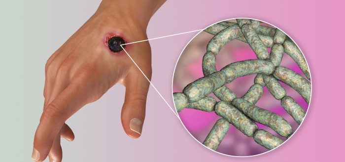 Antrax je vysoce infekční a přenáší se alimentární cestou, kůží přes oděrky nebo skrze dýchací soustavu