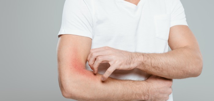Svědění kůže může být příznakem rakoviny i HIV