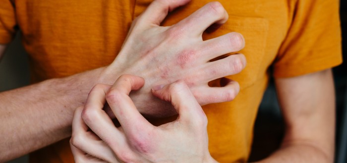 Pokud trpíte psoriázou, je důležité udržovat vaši pokožku neustále hydratovanou