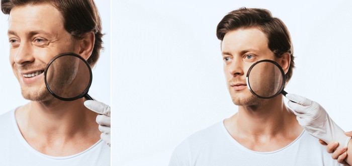 Na obličeji nám žijí roztoči, kteří mohou mimo jiné způsobit i podráždění kolem očí nebo růžovku