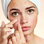 Akné je nejběžnější během puberty; obtěžuje více než 85 % mladistvých a často přetrvává až do dospělosti