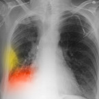 Rakovina plic u nás sice malinko ustává, ale pořád je třeba se mít na pozoru. Jaké jsou statistiky? Podívejte se do naší fotogalerie