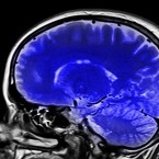 Nemoc způsobuje odumírání mozkových buněk produkujících neuropřenašeč dopamin