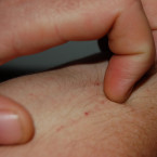 Lidí s lupénkou přibývá. I těch vážnějších případů