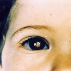 Retinoblastom - rakovina oka, která se objevuje hlavně u dětí 