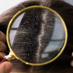 Nejčastější příčina lupů je seboroická dermatitida